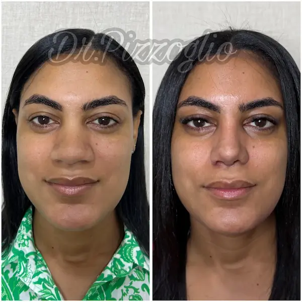 Rhinoplasty result case #4 - aesthetic nose surgery Santo Domingo