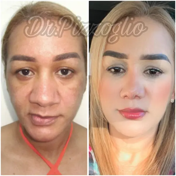 Rhinoplasty result case #7 - functional and aesthetic nasal surgery