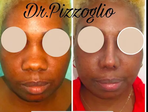 Rhinoplasty result case #10 - aesthetic nasal correction