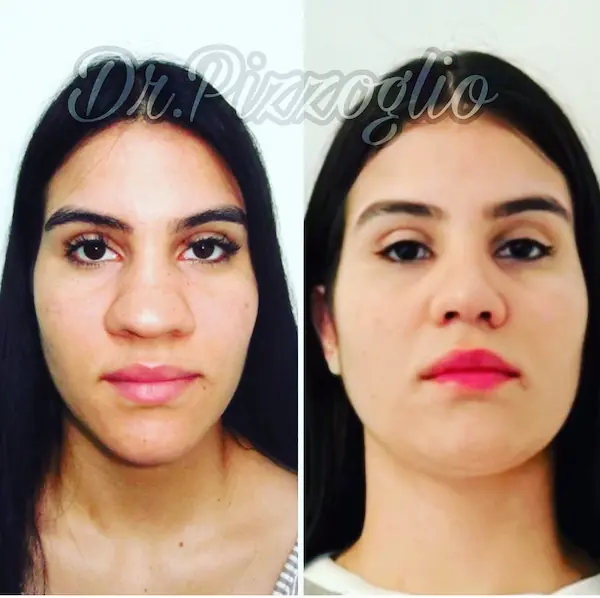 Rhinoplasty result case #12 - real results Dr. Hernández Pizzoglio