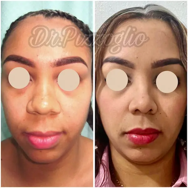 Rhinoplasty result case #13 - aesthetic nose Santo Domingo