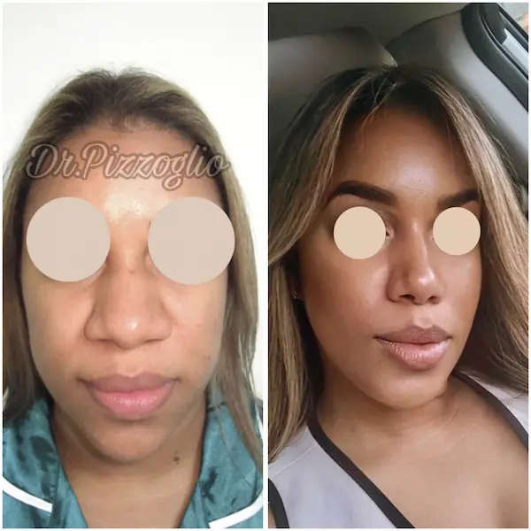 Rhinoplasty result case #14 - satisfied patient after nose surgery