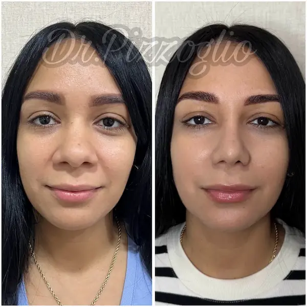 Rhinoplasty result case #1 - Dr. Alejandro Hernández Pizzoglio, Santo Domingo Dominican Republic