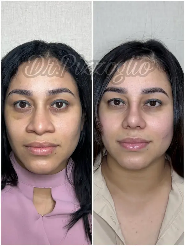 Rhinoplasty result case #6 - Dr. Hernández nose specialist Dominican Republic