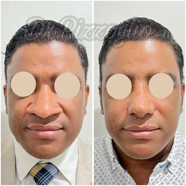 Rhinoplasty result case #5 - nose harmonized with facial features