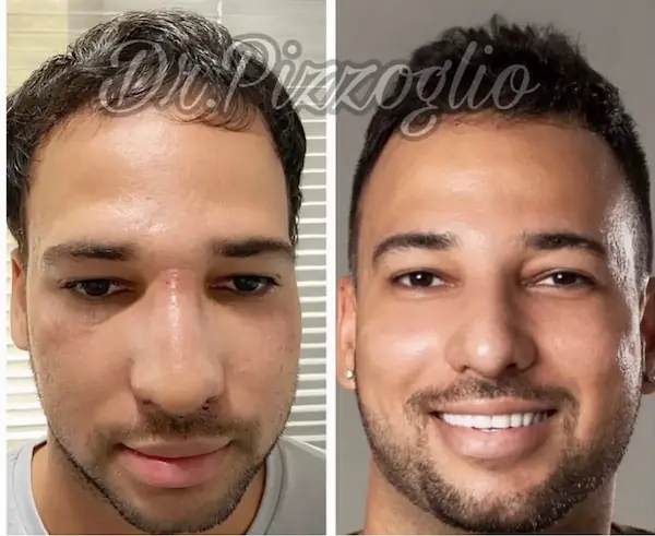 Rhinoplasty result case #2 - aesthetic nose surgery Dominican Republic