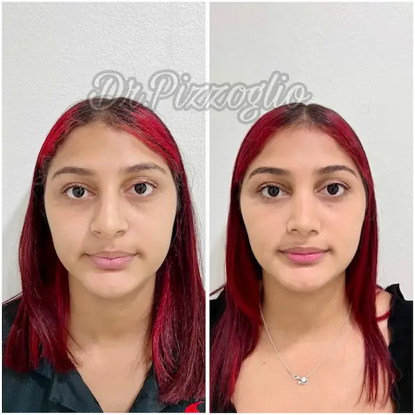 Rhinoplasty result case #3 - natural before and after result