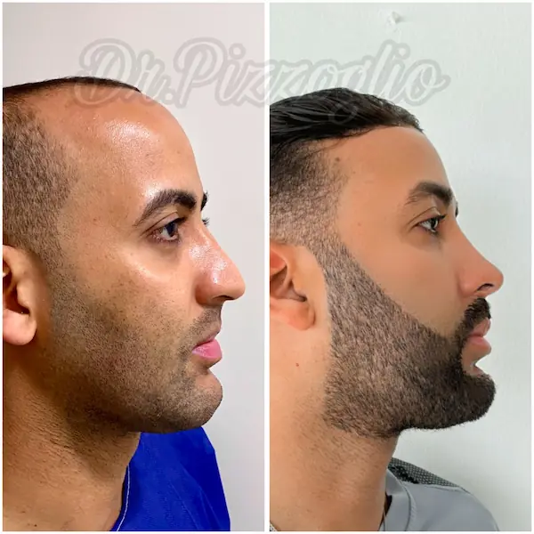 Rhinoplasty result case #8 - natural nasal transformation