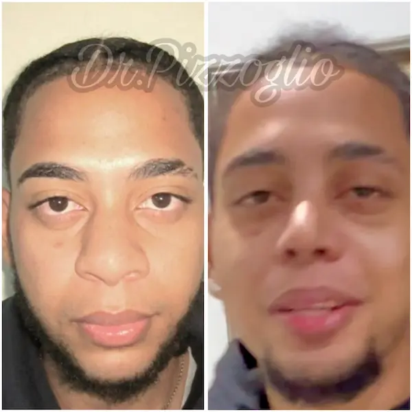 Rhinoplasty result case #11 - facial harmony after rhinoplasty